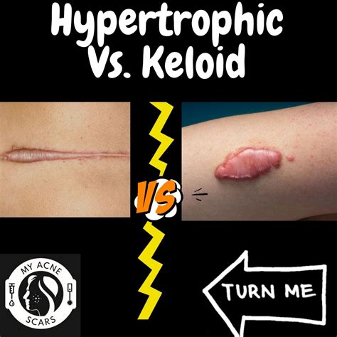 Keloids occur after skin injury; rarely, keloids can occur spontaneously without. . Hypertrophic scar treatment reddit